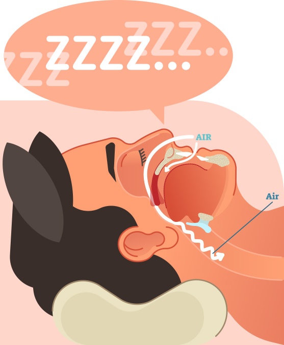 Sleep Apnea and Sleeping Positions Which is Best (or Worst)?